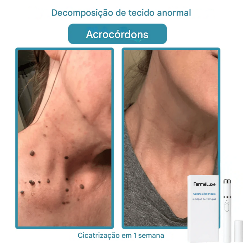 Caneta Laser FerméLuxe para Remoção de Verrugas {SOMENTE HOJE}