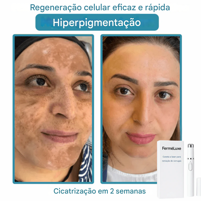 Caneta Laser FerméLuxe para Remoção de Verrugas {SOMENTE HOJE}