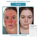 Caneta Laser FerméLuxe para Remoção de Verrugas {SOMENTE HOJE}