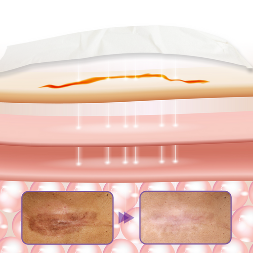 Fita de pele com microagulhas Timilk® HyaRepair (Somente HOJE!)