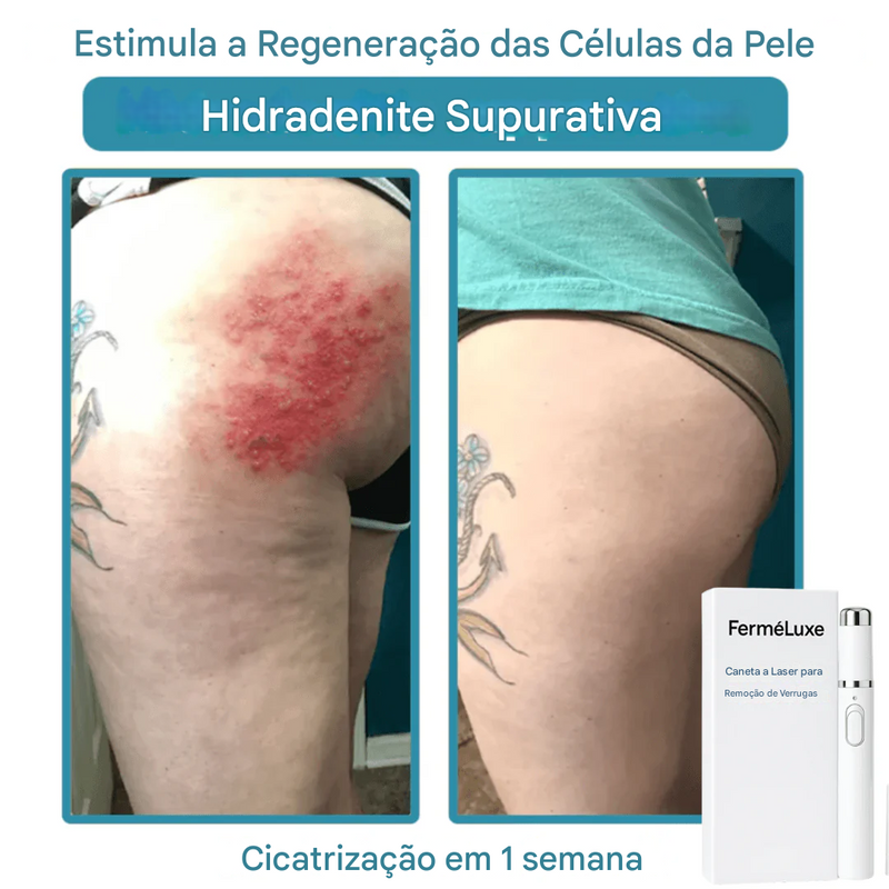 Caneta Laser FerméLuxe para Remoção de Verrugas {SOMENTE HOJE}